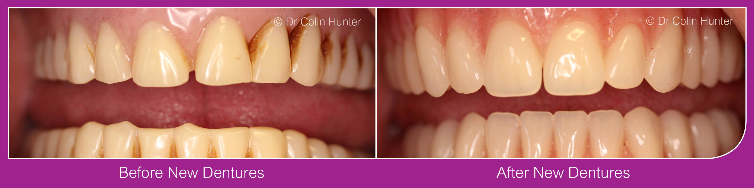 Denture Dentist Kilbirnie, Beith, Dalry